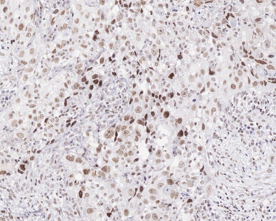 Immunohistochemistry: Menin Antibody (JE30-97) [NBP3-32588] - Immunohistochemical analysis of paraffin-embedded human lung cancer tissue with Rabbit anti-Menin antibody (NBP3-32588) at 1/200 dilution. The section was pre-treated using heat mediated antigen retrieval with Tris-EDTA buffer (pH 9.0) for 20 minutes. The tissues were blocked in 1% BSA for 20 minutes at room temperature, washed with ddH2O and PBS, and then probed with the primary antibody (NBP3-32588) at 1/200 dilution for 1 hour at room temperature. The detection was performed using an HRP conjugated compact polymer system. DAB was used as the chromogen. Tissues were counterstained with hematoxylin and mounted with DPX.