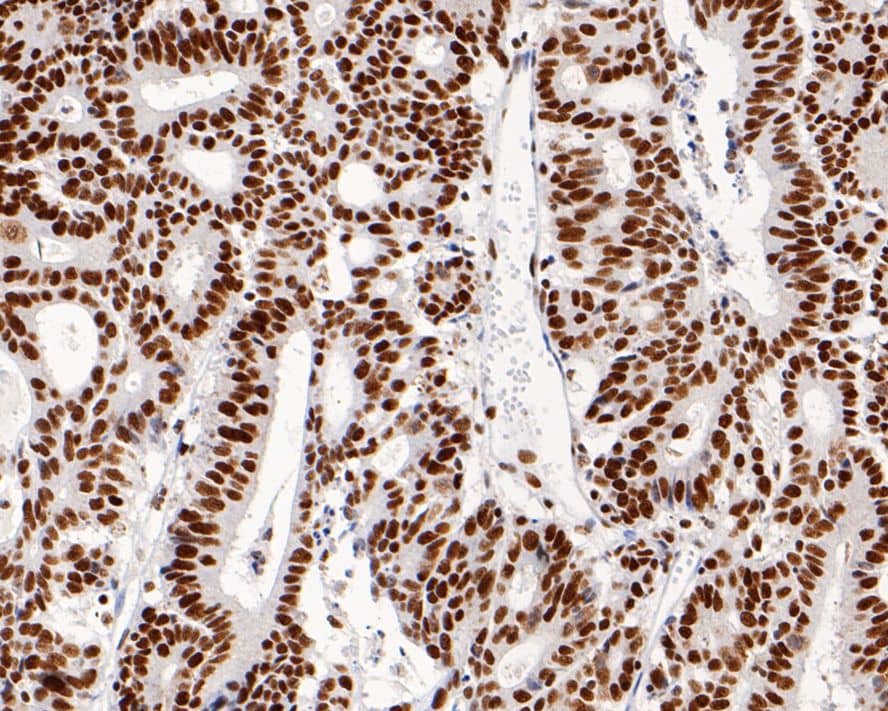 Immunohistochemistry: MSH2 Antibody (10G3-R) [NBP3-32604] - Immunohistochemical analysis of paraffin-embedded human colon cancer tissue with Mouse anti-MSH2 antibody (NBP3-32604) at 1/1,000 dilution. The section was pre-treated using heat mediated antigen retrieval with Tris-EDTA buffer (pH 9.0) for 20 minutes. The tissues were blocked in 1% BSA for 20 minutes at room temperature, washed with ddH2O and PBS, and then probed with the primary antibody (NBP3-32604) at 1/1,000 dilution for 1 hour at room temperature. The detection was performed using an HRP conjugated compact polymer system. DAB was used as the chromogen. Tissues were counterstained with hematoxylin and mounted with DPX.