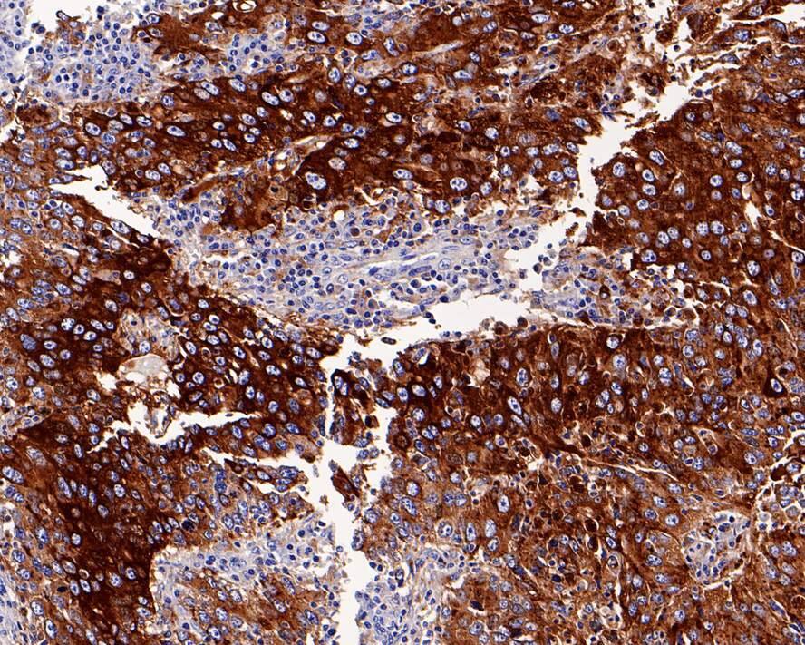 Immunohistochemistry: Napsin A Antibody (PD01-30) [NBP3-32634] - Immunohistochemical analysis of paraffin-embedded human lung carcinoma tissue with Rabbit anti-Napsin A antibody (NBP3-32634) at 1/1,000 dilution. The section was pre-treated using heat mediated antigen retrieval with Tris-EDTA buffer (pH 9.0) for 20 minutes. The tissues were blocked in 1% BSA for 20 minutes at room temperature, washed with ddH2O and PBS, and then probed with the primary antibody (NBP3-32634) at 1/1,000 dilution for 1 hour at room temperature. The detection was performed using an HRP conjugated compact polymer system. DAB was used as the chromogen. Tissues were counterstained with hematoxylin and mounted with DPX.
