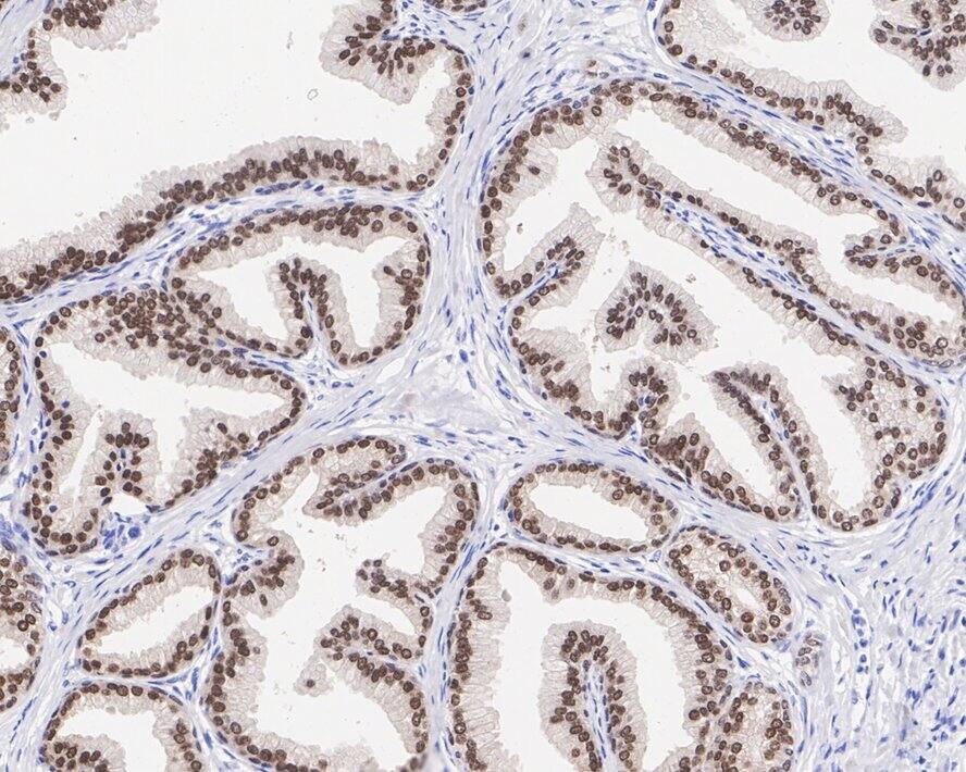 Immunohistochemistry: NKX3.1 Antibody (JE36-27) [NBP3-32655] - Immunohistochemical analysis of paraffin-embedded human prostate tissue with Rabbit anti-NKX3.1 antibody (NBP3-32655) at 1/1,000 dilution. The section was pre-treated using heat mediated antigen retrieval with sodium citrate buffer (pH 6.0) for 2 minutes. The tissues were blocked in 1% BSA for 20 minutes at room temperature, washed with ddH2O and PBS, and then probed with the primary antibody (NBP3-32655) at 1/1,000 dilution for 1 hour at room temperature. The detection was performed using an HRP conjugated compact polymer system. DAB was used as the chromogen. Tissues were counterstained with hematoxylin and mounted with DPX.