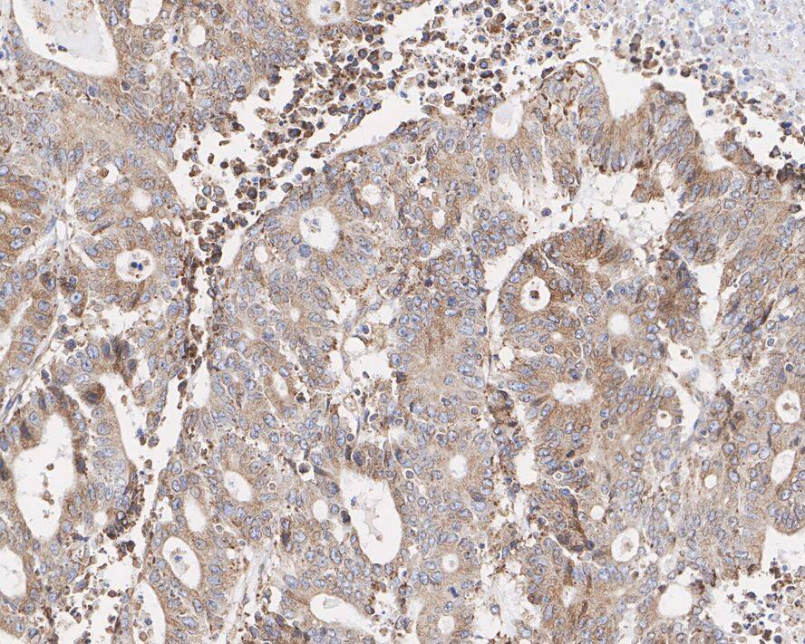 Immunohistochemistry: NSDHL Antibody (PSH02-36) [NBP3-32663] - Immunohistochemical analysis of paraffin-embedded human colon cancer tissue with Rabbit anti-NSDHL antibody (NBP3-32663) at 1/1,000 dilution. The section was pre-treated using heat mediated antigen retrieval with Tris-EDTA buffer (pH 9.0) for 20 minutes. The tissues were blocked in 1% BSA for 20 minutes at room temperature, washed with ddH2O and PBS, and then probed with the primary antibody (NBP3-32663) at 1/1,000 dilution for 1 hour at room temperature. The detection was performed using an HRP conjugated compact polymer system. DAB was used as the chromogen. Tissues were counterstained with hematoxylin and mounted with DPX.