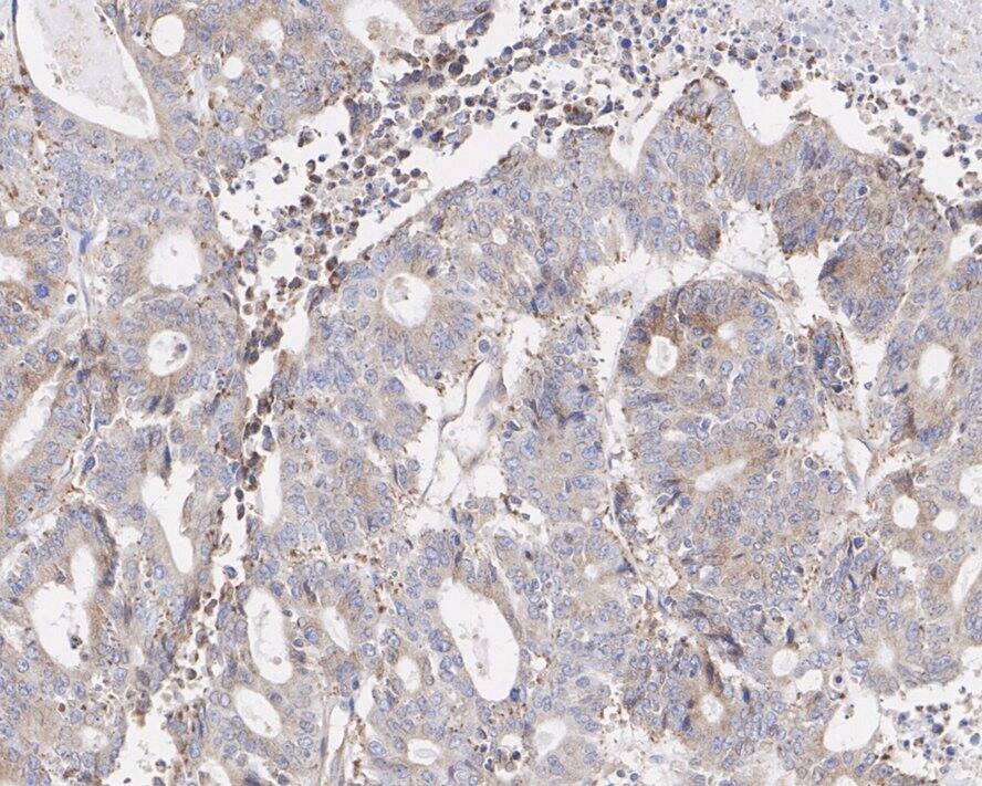 Immunohistochemistry: NSDHL Antibody (PSH02-37) [NBP3-32664] - Immunohistochemical analysis of paraffin-embedded human colon cancer tissue with Rabbit anti-NSDHL antibody (NBP3-32664) at 1/1,000 dilution. The section was pre-treated using heat mediated antigen retrieval with Tris-EDTA buffer (pH 9.0) for 20 minutes. The tissues were blocked in 1% BSA for 20 minutes at room temperature, washed with ddH2O and PBS, and then probed with the primary antibody (NBP3-32664) at 1/1,000 dilution for 1 hour at room temperature. The detection was performed using an HRP conjugated compact polymer system. DAB was used as the chromogen. Tissues were counterstained with hematoxylin and mounted with DPX.