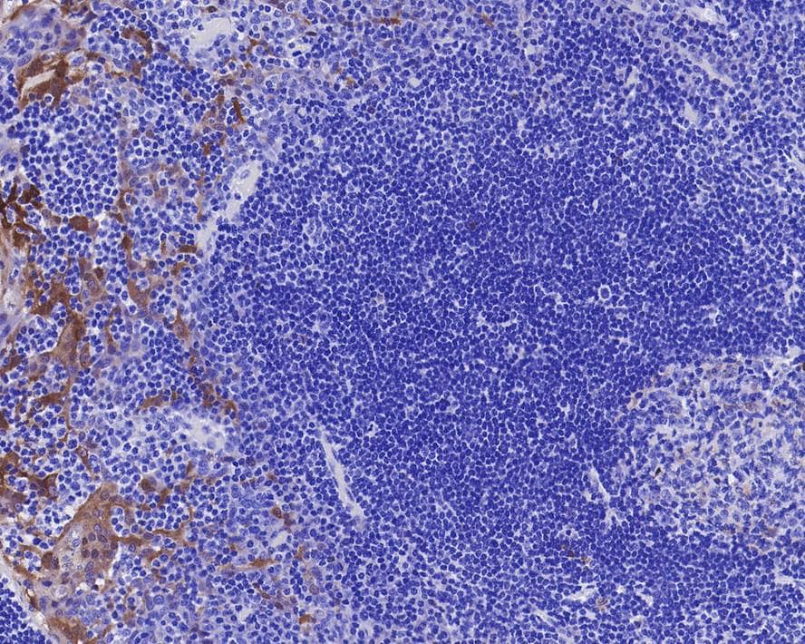 Immunohistochemistry: p16INK4a/CDKN2A Antibody (PD01-16) [NBP3-32688] - Immunohistochemical analysis of paraffin-embedded human tonsil tissue with Mouse anti-p16INK4a/CDKN2A antibody (NBP3-32688) at 1/500 dilution. The section was pre-treated using heat mediated antigen retrieval with sodium citrate buffer (pH 6.0) for 2 minutes. The tissues were blocked in 1% BSA for 20 minutes at room temperature, washed with ddH2O and PBS, and then probed with the primary antibody (NBP3-32688) at 1/500 dilution for 1 hour at room temperature. The detection was performed using an HRP conjugated compact polymer system. DAB was used as the chromogen. Tissues were counterstained with hematoxylin and mounted with DPX.