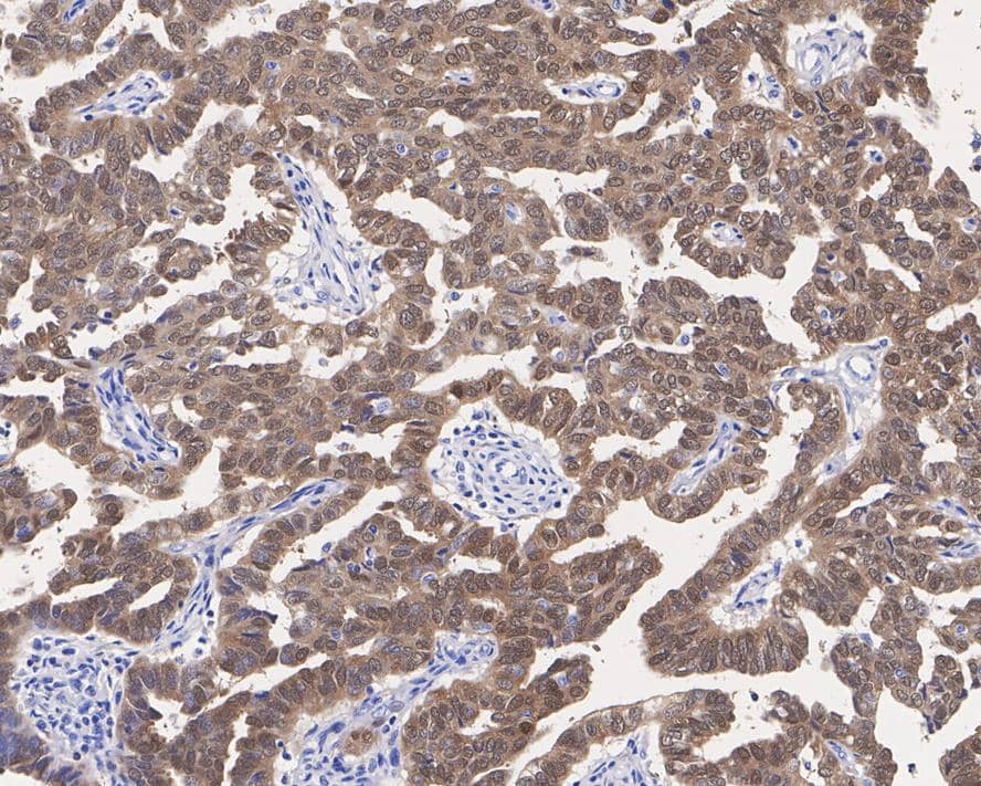 Immunohistochemistry: p16INK4a/CDKN2A Antibody (PD01-16) [NBP3-32689] - Immunohistochemical analysis of paraffin-embedded human ovary carcinoma tissue with Rabbit anti-p16INK4a/CDKN2A antibody (NBP3-32689) at 1/1,000 dilution. The section was pre-treated using heat mediated antigen retrieval with sodium citrate buffer (pH 6.0) for 2 minutes. The tissues were blocked in 1% BSA for 20 minutes at room temperature, washed with ddH2O and PBS, and then probed with the primary antibody (NBP3-32689) at 1/1,000 dilution for 1 hour at room temperature. The detection was performed using an HRP conjugated compact polymer system. DAB was used as the chromogen. Tissues were counterstained with hematoxylin and mounted with DPX.