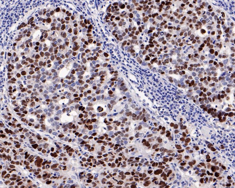 Immunohistochemistry: p53 Antibody (PD01-32) [NBP3-32699] - Immunohistochemical analysis of paraffin-embedded human stomach cancer tissue with Rabbit anti-p53 antibody (NBP3-32699) at 1/2,000 dilution. The section was pre-treated using heat mediated antigen retrieval with Tris-EDTA buffer (pH 9.0) for 20 minutes. The tissues were blocked in 1% BSA for 20 minutes at room temperature, washed with ddH2O and PBS, and then probed with the primary antibody (NBP3-32699) at 1/2,000 dilution for 1 hour at room temperature. The detection was performed using an HRP conjugated compact polymer system. DAB was used as the chromogen. Tissues were counterstained with hematoxylin and mounted with DPX.