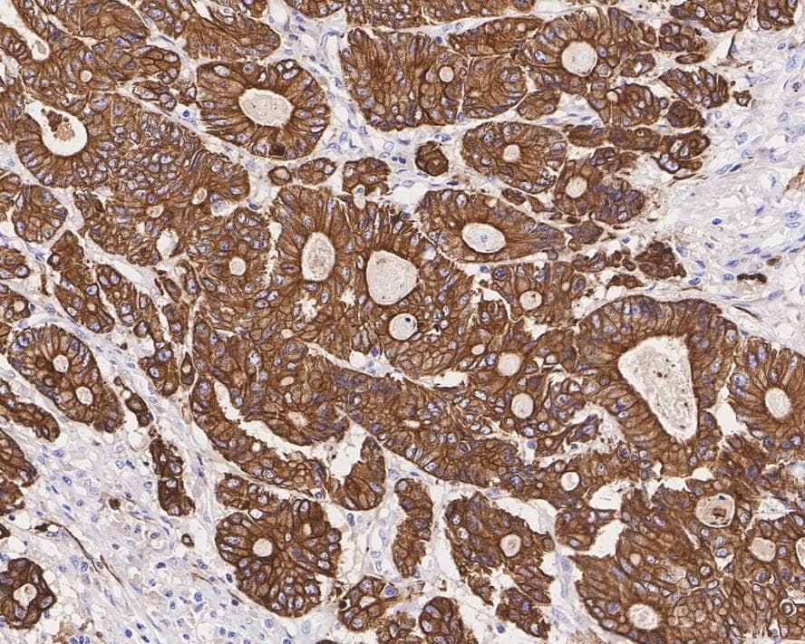 Immunohistochemistry: Cytokeratin, pan Antibody (PDH09-10) [NBP3-32711] - Immunohistochemical analysis of paraffin-embedded human colon carcinoma tissue with Mouse anti-Cytokeratin, pan antibody (NBP3-32711) at 1/2,000 dilution. The section was pre-treated using heat mediated antigen retrieval with Tris-EDTA buffer (pH 9.0) for 20 minutes. The tissues were blocked in 1% BSA for 20 minutes at room temperature, washed with ddH2O and PBS, and then probed with the primary antibody (NBP3-32711) at 1/2,000 dilution for 1 hour at room temperature. The detection was performed using an HRP conjugated compact polymer system. DAB was used as the chromogen. Tissues were counterstained with hematoxylin and mounted with DPX.