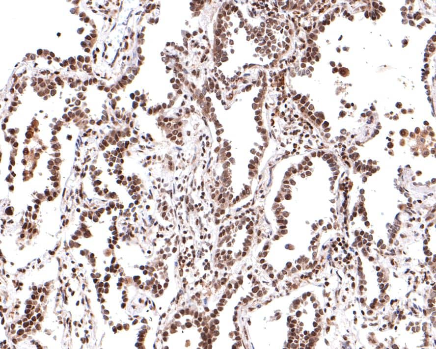 Immunohistochemistry: PER2 Antibody (JE33-79) [NBP3-32735] - Immunohistochemical analysis of paraffin-embedded human lung carcinoma tissue with Rabbit anti-PER2 antibody (NBP3-32735) at 1/400 dilution. The section was pre-treated using heat mediated antigen retrieval with sodium citrate buffer (pH 6.0) for 2 minutes. The tissues were blocked in 1% BSA for 20 minutes at room temperature, washed with ddH2O and PBS, and then probed with the primary antibody (NBP3-32735) at 1/400 dilution for 1 hour at room temperature. The detection was performed using an HRP conjugated compact polymer system. DAB was used as the chromogen. Tissues were counterstained with hematoxylin and mounted with DPX.