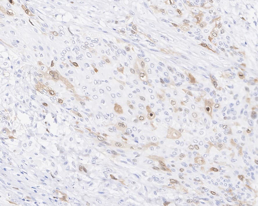 Immunohistochemistry: CDC2/CDK1 [p Thr161] Antibody (PSH03-42) [NBP3-32753] - Immunohistochemical analysis of paraffin-embedded human cervix cancer tissue with Rabbit anti-CDC2/CDK1 antibody (NBP3-32753) at 1/200 dilution. The section was pre-treated using heat mediated antigen retrieval with sodium citrate buffer (pH 6.0) for 2 minutes. The tissues were blocked in 1% BSA for 20 minutes at room temperature, washed with ddH2O and PBS, and then probed with the primary antibody (NBP3-32753) at 1/200 dilution for 1 hour at room temperature. The detection was performed using an HRP conjugated compact polymer system. DAB was used as the chromogen. Tissues were counterstained with hematoxylin and mounted with DPX.