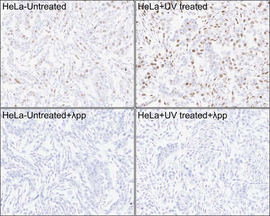 Immunohistochemistry: Chk1 [p Ser317] Antibody (PSH03-84) [NBP3-32755] - Immunohistochemical analysis of paraffin-embedded HeLa cells treated with or without UV for 40 minutes with Rabbit anti-Chk1 antibody (NBP3-32755) at 1/1,000 dilution. The section was pre-treated using heat mediated antigen retrieval with sodium citrate buffer (pH 6.0) for 2 minutes. The tissues were blocked in 1% BSA for 20 minutes at room temperature, washed with ddH2O and PBS, and then probed with the primary antibody (NBP3-32755) at 1/1,000 dilution for 1 hour at room temperature. The detection was performed using an HRP conjugated compact polymer system. DAB was used as the chromogen. Tissues were counterstained with hematoxylin and mounted with DPX.