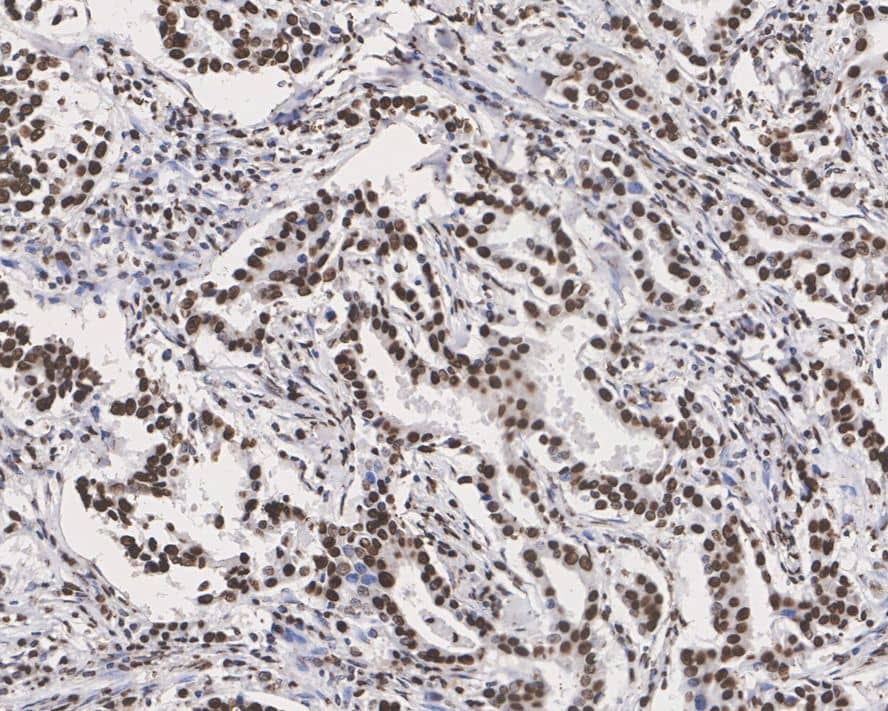 Immunohistochemistry: p70 S6 Kinase/S6K [p Thr389] Antibody (PSH02-23) [NBP3-32783] - Immunohistochemical analysis of paraffin-embedded human breast carcinoma tissue with Rabbit anti-p70 S6 Kinase/S6K antibody (NBP3-32783) at 1/1,000 dilution. The section was pre-treated using heat mediated antigen retrieval with sodium citrate buffer (pH 6.0) for 2 minutes. The tissues were blocked in 1% BSA for 20 minutes at room temperature, washed with ddH2O and PBS, and then probed with the primary antibody (NBP3-32783) at 1/1,000 dilution for 1 hour at room temperature. The detection was performed using an HRP conjugated compact polymer system. DAB was used as the chromogen. Tissues were counterstained with hematoxylin and mounted with DPX.