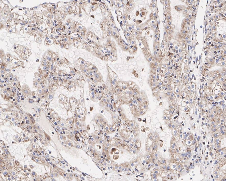 Immunohistochemistry: Pyruvate Dehydrogenase E1-alpha subunit [p Ser293] Antibody (JE58-27) [NBP3-32787] - Immunohistochemical analysis of paraffin-embedded human renal clear cell carcinoma tissue with Rabbit anti-Pyruvate Dehydrogenase E1-alpha subunit antibody (NBP3-32787) at 1/500 dilution. The section was pre-treated using heat mediated antigen retrieval with Tris-EDTA buffer (pH 9.0) for 20 minutes. The tissues were blocked in 1% BSA for 20 minutes at room temperature, washed with ddH2O and PBS, and then probed with the primary antibody (NBP3-32787) at 1/500 dilution for 1 hour at room temperature. The detection was performed using an HRP conjugated compact polymer system. DAB was used as the chromogen. Tissues were counterstained with hematoxylin and mounted with DPX.