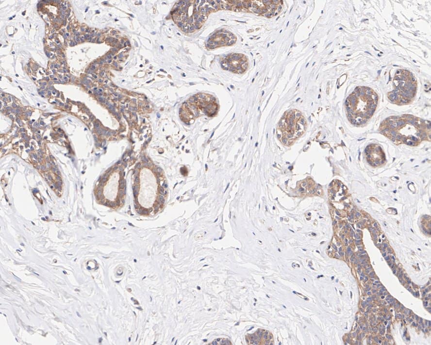 Immunohistochemistry: PICALM Antibody (PSH01-63) [NBP3-32821] - Immunohistochemical analysis of paraffin-embedded human breast tissue with Rabbit anti-PICALM antibody (NBP3-32821) at 1/50 dilution. The section was pre-treated using heat mediated antigen retrieval with sodium citrate buffer (pH 6.0) for 2 minutes. The tissues were blocked in 1% BSA for 20 minutes at room temperature, washed with ddH2O and PBS, and then probed with the primary antibody (NBP3-32821) at 1/50 dilution for 1 hour at room temperature. The detection was performed using an HRP conjugated compact polymer system. DAB was used as the chromogen. Tissues were counterstained with hematoxylin and mounted with DPX.