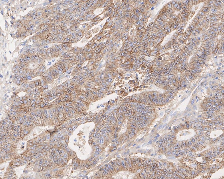 Immunohistochemistry: Plexin B2 Antibody (PSH03-48) [NBP3-32828] - Immunohistochemical analysis of paraffin-embedded human colon cancer tissue with Rabbit anti-Plexin B2 antibody (NBP3-32828) at 1/2,000 dilution. The section was pre-treated using heat mediated antigen retrieval with Tris-EDTA buffer (pH 9.0) for 20 minutes. The tissues were blocked in 1% BSA for 20 minutes at room temperature, washed with ddH2O and PBS, and then probed with the primary antibody (NBP3-32828) at 1/2,000 dilution for 1 hour at room temperature. The detection was performed using an HRP conjugated compact polymer system. DAB was used as the chromogen. Tissues were counterstained with hematoxylin and mounted with DPX.