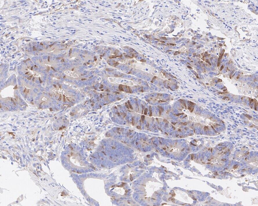 Immunohistochemistry: PLK1 Antibody (PSH04-35) [NBP3-32829] - Immunohistochemical analysis of paraffin-embedded human colon cancer tissue with Rabbit anti-PLK1 antibody (NBP3-32829) at 1/200 dilution. The section was pre-treated using heat mediated antigen retrieval with sodium citrate buffer (pH 6.0) for 2 minutes. The tissues were blocked in 1% BSA for 20 minutes at room temperature, washed with ddH2O and PBS, and then probed with the primary antibody (NBP3-32829) at 1/200 dilution for 1 hour at room temperature. The detection was performed using an HRP conjugated compact polymer system. DAB was used as the chromogen. Tissues were counterstained with hematoxylin and mounted with DPX.