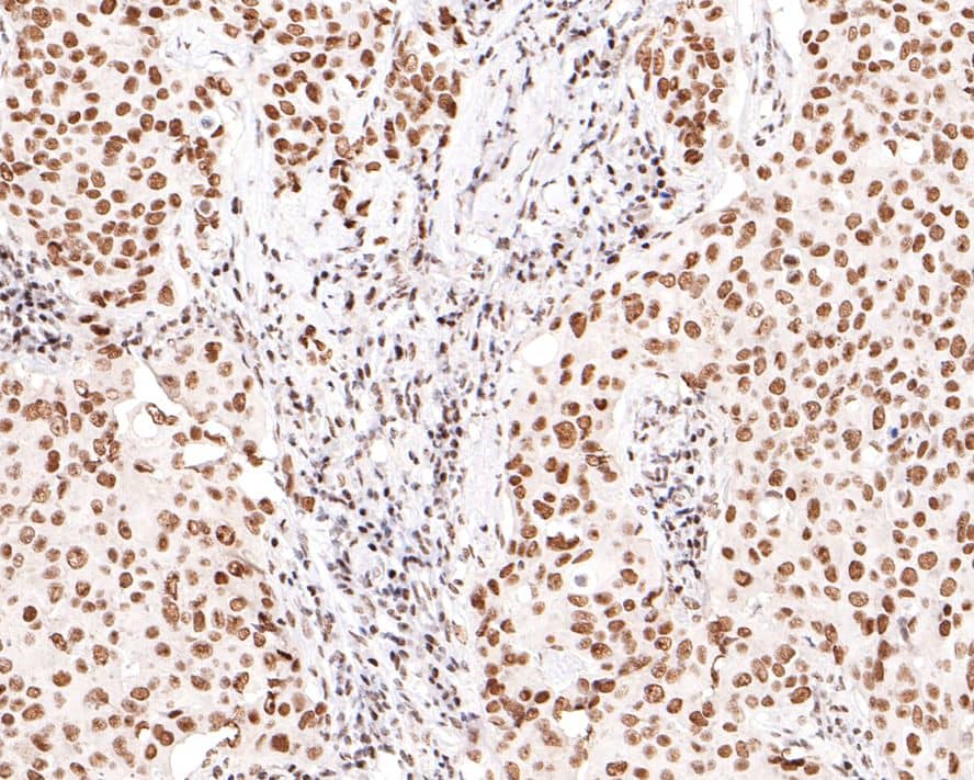 Immunohistochemistry: PNK Antibody (JE64-21) [NBP3-32835] - Immunohistochemical analysis of paraffin-embedded human breast carcinoma tissue with Rabbit anti-PNK antibody (NBP3-32835) at 1/400 dilution. The section was pre-treated using heat mediated antigen retrieval with sodium citrate buffer (pH 6.0) for 2 minutes. The tissues were blocked in 1% BSA for 20 minutes at room temperature, washed with ddH2O and PBS, and then probed with the primary antibody (NBP3-32835) at 1/400 dilution for 1 hour at room temperature. The detection was performed using an HRP conjugated compact polymer system. DAB was used as the chromogen. Tissues were counterstained with hematoxylin and mounted with DPX.