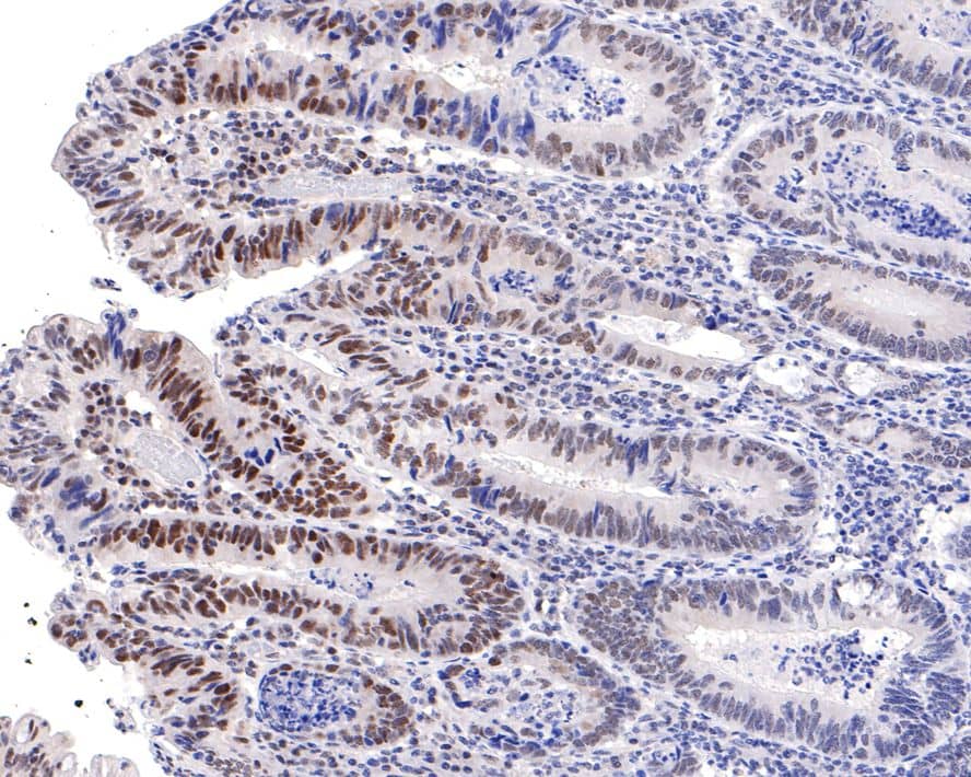 Immunohistochemistry: PNK Antibody (JE64-85) [NBP3-32836] - Immunohistochemical analysis of paraffin-embedded human colon carcinoma tissue with Rabbit anti-PNK antibody (NBP3-32836) at 1/100 dilution. The section was pre-treated using heat mediated antigen retrieval with sodium citrate buffer (pH 6.0) for 2 minutes. The tissues were blocked in 1% BSA for 20 minutes at room temperature, washed with ddH2O and PBS, and then probed with the primary antibody (NBP3-32836) at 1/100 dilution for 1 hour at room temperature. The detection was performed using an HRP conjugated compact polymer system. DAB was used as the chromogen. Tissues were counterstained with hematoxylin and mounted with DPX.