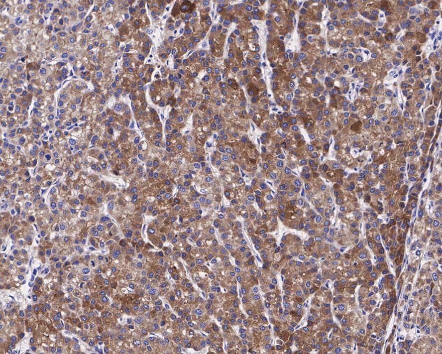 Immunohistochemistry: PON1 Antibody (JE30-90) [NBP3-32843] - Immunohistochemical analysis of paraffin-embedded human liver carcinoma tissue with Rabbit anti-PON1 antibody (NBP3-32843) at 1/200 dilution. The section was pre-treated using heat mediated antigen retrieval with Tris-EDTA buffer (pH 9.0) for 20 minutes. The tissues were blocked in 1% BSA for 20 minutes at room temperature, washed with ddH2O and PBS, and then probed with the primary antibody (NBP3-32843) at 1/200 dilution for 1 hour at room temperature. The detection was performed using an HRP conjugated compact polymer system. DAB was used as the chromogen. Tissues were counterstained with hematoxylin and mounted with DPX.