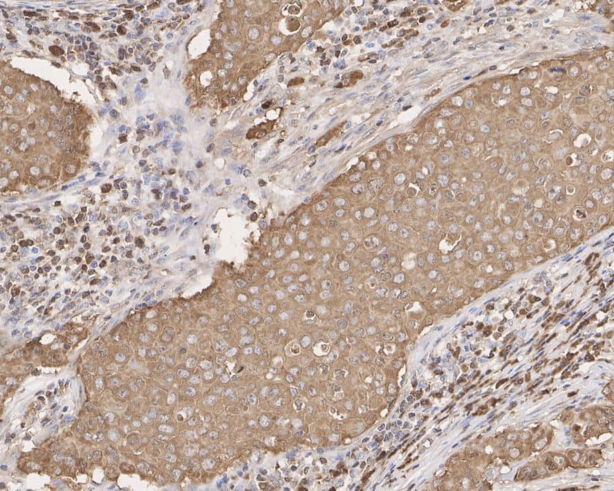 Immunohistochemistry: Peroxiredoxin 2 Antibody (7F5-R) [NBP3-32851] - Immunohistochemical analysis of paraffin-embedded human breast carcinoma tissue with Mouse anti-Peroxiredoxin 2 antibody (NBP3-32851) at 1/1,000 dilution. The section was pre-treated using heat mediated antigen retrieval with Tris-EDTA buffer (pH 9.0) for 20 minutes. The tissues were blocked in 1% BSA for 20 minutes at room temperature, washed with ddH2O and PBS, and then probed with the primary antibody (NBP3-32851) at 1/1,000 dilution for 1 hour at room temperature. The detection was performed using an HRP conjugated compact polymer system. DAB was used as the chromogen. Tissues were counterstained with hematoxylin and mounted with DPX.