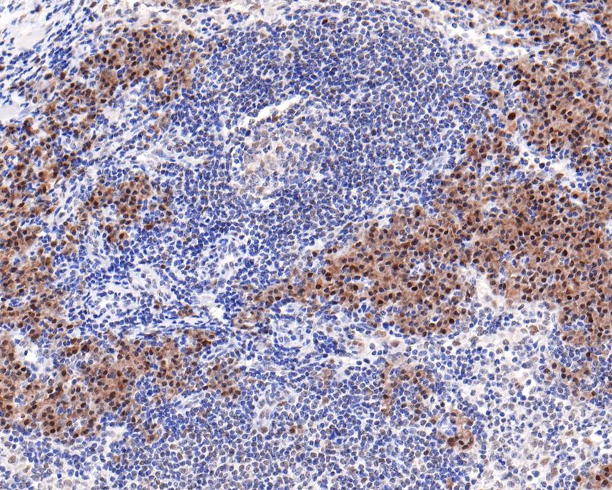Immunohistochemistry: PREB Antibody (JE64-56) [NBP3-32852] - Immunohistochemical analysis of paraffin-embedded human lymph nodes tissue with Rabbit anti-PREB antibody (NBP3-32852) at 1/400 dilution. The section was pre-treated using heat mediated antigen retrieval with sodium citrate buffer (pH 6.0) for 2 minutes. The tissues were blocked in 1% BSA for 20 minutes at room temperature, washed with ddH2O and PBS, and then probed with the primary antibody (NBP3-32852) at 1/400 dilution for 1 hour at room temperature. The detection was performed using an HRP conjugated compact polymer system. DAB was used as the chromogen. Tissues were counterstained with hematoxylin and mounted with DPX.