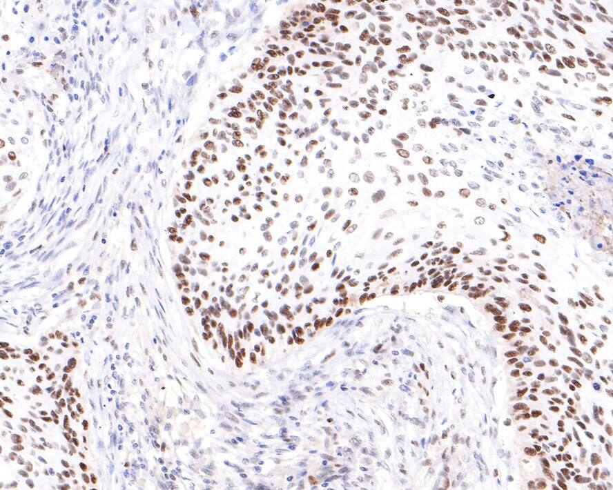 Immunohistochemistry: PRPF4 Antibody (JE65-37) [NBP3-32858] - Immunohistochemical analysis of paraffin-embedded human cervical carcinoma tissue with Rabbit anti-PRPF4 antibody (NBP3-32858) at 1/400 dilution. The section was pre-treated using heat mediated antigen retrieval with sodium citrate buffer (pH 6.0) for 2 minutes. The tissues were blocked in 1% BSA for 20 minutes at room temperature, washed with ddH2O and PBS, and then probed with the primary antibody (NBP3-32858) at 1/400 dilution for 1 hour at room temperature. The detection was performed using an HRP conjugated compact polymer system. DAB was used as the chromogen. Tissues were counterstained with hematoxylin and mounted with DPX.