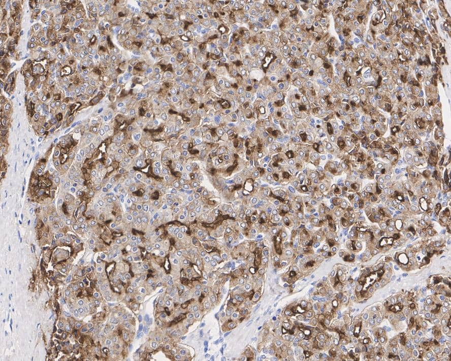 Immunohistochemistry: PSMA/FOLH1/NAALADase I Antibody (JE42-45) [NBP3-32861] - Immunohistochemical analysis of paraffin-embedded human prostate carcinoma tissue with Rabbit anti-PSMA/FOLH1/NAALADase I antibody (NBP3-32861) at 1/1,000 dilution. The section was pre-treated using heat mediated antigen retrieval with Tris-EDTA buffer (pH 9.0) for 20 minutes. The tissues were blocked in 1% BSA for 20 minutes at room temperature, washed with ddH2O and PBS, and then probed with the primary antibody (NBP3-32861) at 1/1,000 dilution for 1 hour at room temperature. The detection was performed using an HRP conjugated compact polymer system. DAB was used as the chromogen. Tissues were counterstained with hematoxylin and mounted with DPX.