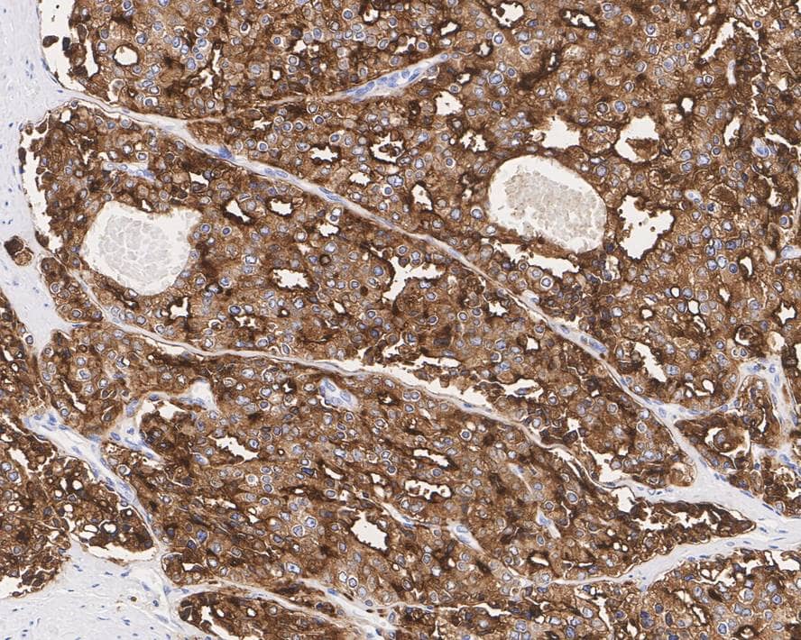 Immunohistochemistry: PSMA/FOLH1/NAALADase I Antibody (PD00-72) [NBP3-32862] - Immunohistochemical analysis of paraffin-embedded human prostate cancer tissue with Rabbit anti-PSMA/FOLH1/NAALADase I antibody (NBP3-32862) at 1/1,000 dilution. The section was pre-treated using heat mediated antigen retrieval with Tris-EDTA buffer (pH 9.0) for 20 minutes. The tissues were blocked in 1% BSA for 20 minutes at room temperature, washed with ddH2O and PBS, and then probed with the primary antibody (NBP3-32862) at 1/1,000 dilution for 1 hour at room temperature. The detection was performed using an HRP conjugated compact polymer system. DAB was used as the chromogen. Tissues were counterstained with hematoxylin and mounted with DPX.