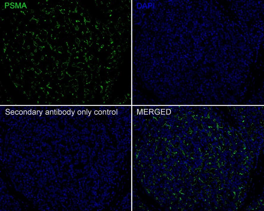 Immunohistochemistry: PSMA/FOLH1/NAALADase I Antibody (PD00-72) [NBP3-32862] - Immunofluorescence analysis of paraffin-embedded human prostate cancer tissue labeling PSMA/FOLH1/NAALADase I with Rabbit anti-PSMA/FOLH1/NAALADase I antibody (NBP3-32862) at 1/200 dilution. The section was pre-treated using heat mediated antigen retrieval with Tris-EDTA buffer (pH 9.0) for 20 minutes. The tissues were blocked in 10% negative goat serum for 1 hour at room temperature, washed with PBS, and then probed with the primary antibody (NBP3-32862, green) at 1/200 dilution overnight at 4 ℃, washed with PBS. Goat Anti-Rabbit IgG H&L (iFluor™ 488) was used as the secondary antibody at 1/1,000 dilution. Nuclei were counterstained with DAPI (blue).