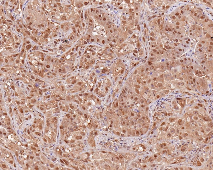 Immunohistochemistry: SUG1 Antibody (PSH0-22) [NBP3-32865] - Immunohistochemical analysis of paraffin-embedded human lung carcinoma tissue with Rabbit anti-SUG1 antibody (NBP3-32865) at 1/1,000 dilution. The section was pre-treated using heat mediated antigen retrieval with sodium citrate buffer (pH 6.0) for 2 minutes. The tissues were blocked in 1% BSA for 20 minutes at room temperature, washed with ddH2O and PBS, and then probed with the primary antibody (NBP3-32865) at 1/1,000 dilution for 1 hour at room temperature. The detection was performed using an HRP conjugated compact polymer system. DAB was used as the chromogen. Tissues were counterstained with hematoxylin and mounted with DPX.