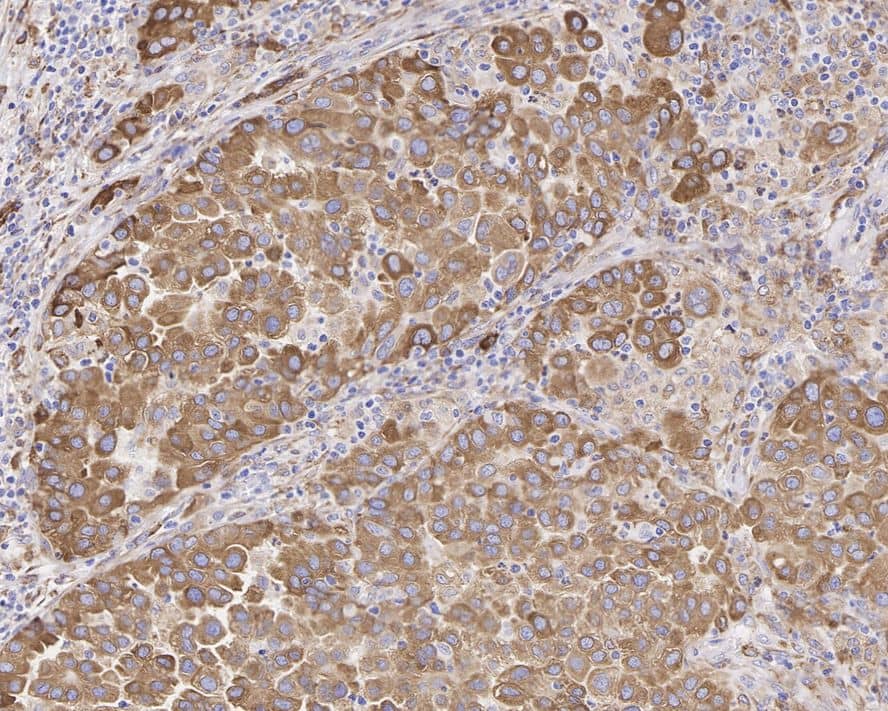 Immunohistochemistry: ROS Antibody (PD01-27) [NBP3-32917] - Immunohistochemical analysis of paraffin-embedded human lung carcinoma tissue with Rabbit anti-ROS antibody (NBP3-32917) at 1/200 dilution. The section was pre-treated using heat mediated antigen retrieval with Tris-EDTA buffer (pH 9.0) for 20 minutes. The tissues were blocked in 1% BSA for 20 minutes at room temperature, washed with ddH2O and PBS, and then probed with the primary antibody (NBP3-32917) at 1/200 dilution for 1 hour at room temperature. The detection was performed using an HRP conjugated compact polymer system. DAB was used as the chromogen. Tissues were counterstained with hematoxylin and mounted with DPX.