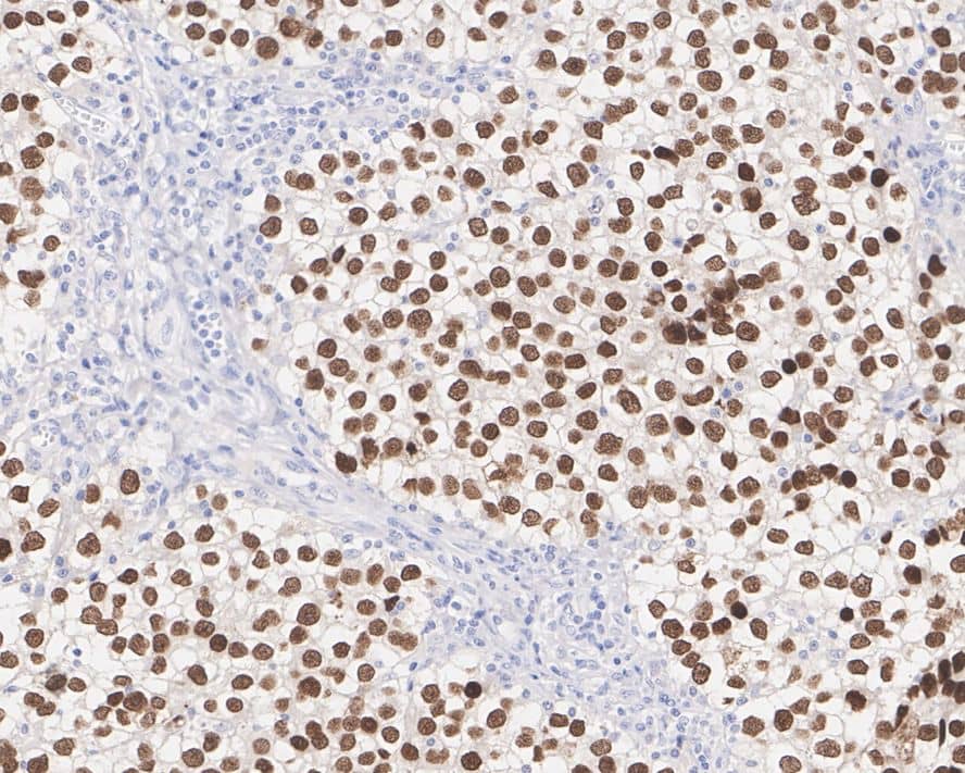 Immunohistochemistry: SALL4 Antibody (A9G9-R) [NBP3-32926] - Immunohistochemical analysis of paraffin-embedded human seminoma tissue with Mouse anti-SALL4 antibody (NBP3-32926) at 1/4,000 dilution. The section was pre-treated using heat mediated antigen retrieval with sodium citrate buffer (pH 6.0) for 2 minutes. The tissues were blocked in 1% BSA for 20 minutes at room temperature, washed with ddH2O and PBS, and then probed with the primary antibody (NBP3-32926) at 1/4,000 dilution for 1 hour at room temperature. The detection was performed using an HRP conjugated compact polymer system. DAB was used as the chromogen. Tissues were counterstained with hematoxylin and mounted with DPX.