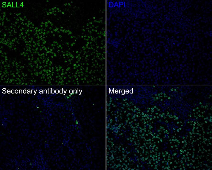 Immunohistochemistry: SALL4 Antibody (A7A7-R) [NBP3-32927] - Immunofluorescence analysis of paraffin-embedded human seminoma tissue labeling SALL4 with Mouse anti-SALL4 antibody (NBP3-32927) at 1/200 dilution. The section was pre-treated using heat mediated antigen retrieval with sodium citrate buffer (pH 6.0) for 2 minutes. The tissues were blocked in 10% negative goat serum for 1 hour at room temperature, washed with PBS, and then probed with the primary antibody (NBP3-32927, green) at 1/200 dilution overnight at 4 ℃, washed with PBS. Goat Anti-Mouse IgG H&L (iFluor™ 488) was used as the secondary antibody at 1/1,000 dilution. Nuclei were counterstained with DAPI (blue).