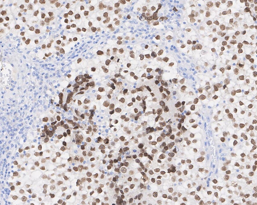 Immunohistochemistry: SALL4 Antibody (A7A7-R) [NBP3-32927] - Immunohistochemical analysis of paraffin-embedded human seminoma tissue with Mouse anti-SALL4 antibody (NBP3-32927) at 1/2,000 dilution. The section was pre-treated using heat mediated antigen retrieval with sodium citrate buffer (pH 6.0) for 2 minutes. The tissues were blocked in 1% BSA for 20 minutes at room temperature, washed with ddH2O and PBS, and then probed with the primary antibody (NBP3-32927) at 1/2,000 dilution for 1 hour at room temperature. The detection was performed using an HRP conjugated compact polymer system. DAB was used as the chromogen. Tissues were counterstained with hematoxylin and mounted with DPX.