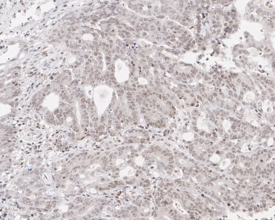 Immunohistochemistry: BRM Antibody (PSH01-15) [NBP3-32957] - Immunohistochemical analysis of paraffin-embedded human colon carcinoma tissue with Rabbit anti-BRM antibody (NBP3-32957) at 1/200 dilution. The section was pre-treated using heat mediated antigen retrieval with sodium citrate buffer (pH 6.0) for 2 minutes. The tissues were blocked in 1% BSA for 20 minutes at room temperature, washed with ddH2O and PBS, and then probed with the primary antibody (NBP3-32957) at 1/200 dilution for 1 hour at room temperature. The detection was performed using an HRP conjugated compact polymer system. DAB was used as the chromogen. Tissues were counterstained with hematoxylin and mounted with DPX.