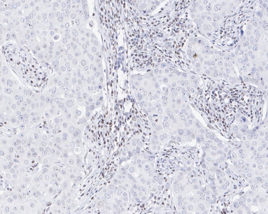 Immunohistochemistry: SMCHD1 Antibody (JE34-29) [NBP3-32960] - Immunohistochemical analysis of paraffin-embedded human breast cancer tissue with Rabbit anti-SMCHD1 antibody (NBP3-32960) at 1/200 dilution. The section was pre-treated using heat mediated antigen retrieval with sodium citrate buffer (pH 6.0) for 2 minutes. The tissues were blocked in 1% BSA for 20 minutes at room temperature, washed with ddH2O and PBS, and then probed with the primary antibody (NBP3-32960) at 1/200 dilution for 1 hour at room temperature. The detection was performed using an HRP conjugated compact polymer system. DAB was used as the chromogen. Tissues were counterstained with hematoxylin and mounted with DPX.