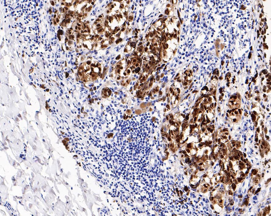 Immunohistochemistry: SOX10 Antibody (PDH0-05) [NBP3-32969] - Immunohistochemical analysis of paraffin-embedded human malignant melanoma tissue with Rabbit anti-SOX10 antibody (NBP3-32969) at 1/3,000 dilution. The section was pre-treated using heat mediated antigen retrieval with sodium citrate buffer (pH 6.0) for 2 minutes. The tissues were blocked in 1% BSA for 20 minutes at room temperature, washed with ddH2O and PBS, and then probed with the primary antibody (NBP3-32969) at 1/3,000 dilution for 1 hour at room temperature. The detection was performed using an HRP conjugated compact polymer system. DAB was used as the chromogen. Tissues were counterstained with hematoxylin and mounted with DPX.