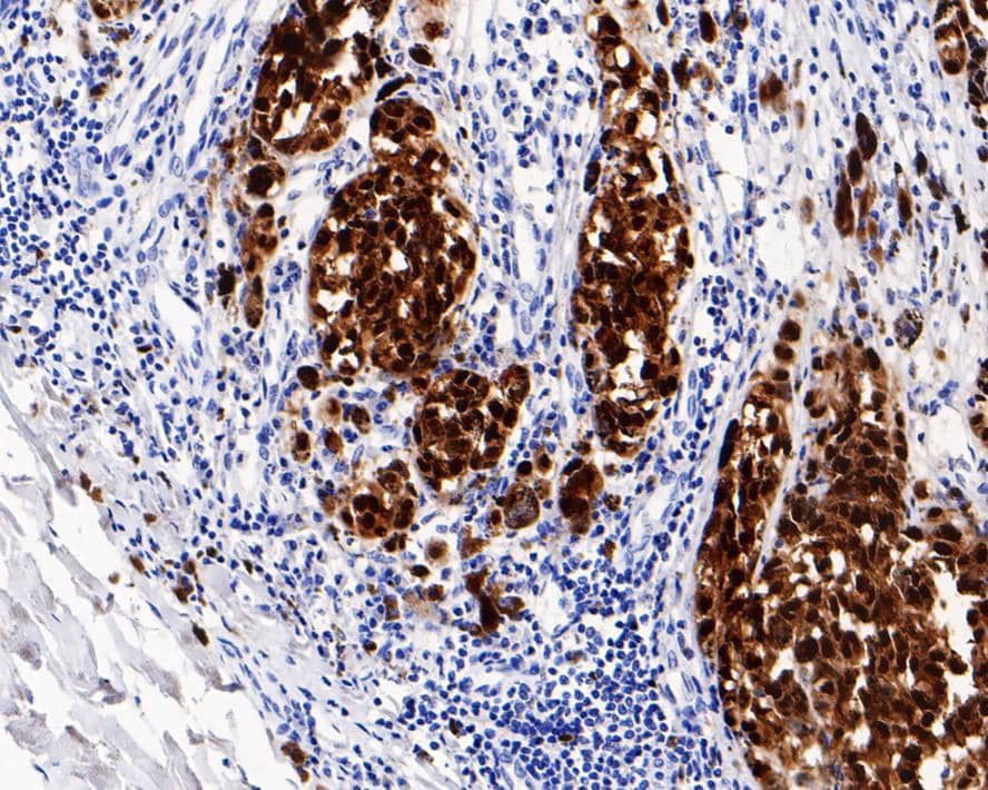 Immunohistochemistry: SOX10 Antibody (PDH0-03) [NBP3-32970] - Immunohistochemical analysis of paraffin-embedded human malignant melanoma tissue with Rabbit anti-SOX10 antibody (NBP3-32970) at 1/3,000 dilution. The section was pre-treated using heat mediated antigen retrieval with sodium citrate buffer (pH 6.0) for 2 minutes. The tissues were blocked in 1% BSA for 20 minutes at room temperature, washed with ddH2O and PBS, and then probed with the primary antibody (NBP3-32970) at 1/3,000 dilution for 1 hour at room temperature. The detection was performed using an HRP conjugated compact polymer system. DAB was used as the chromogen. Tissues were counterstained with hematoxylin and mounted with DPX.