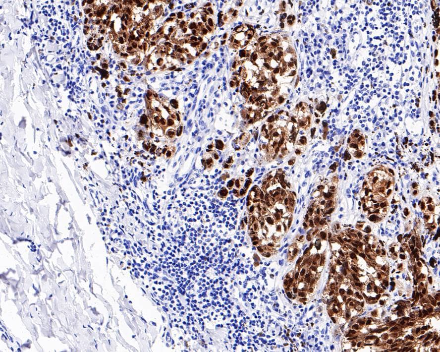 Immunohistochemistry: SOX10 Antibody (PDH0-04) [NBP3-32971] - Immunohistochemical analysis of paraffin-embedded human malignant melanoma tissue with Rabbit anti-SOX10 antibody (NBP3-32971) at 1/3,000 dilution. The section was pre-treated using heat mediated antigen retrieval with sodium citrate buffer (pH 6.0) for 2 minutes. The tissues were blocked in 1% BSA for 20 minutes at room temperature, washed with ddH2O and PBS, and then probed with the primary antibody (NBP3-32971) at 1/3,000 dilution for 1 hour at room temperature. The detection was performed using an HRP conjugated compact polymer system. DAB was used as the chromogen. Tissues were counterstained with hematoxylin and mounted with DPX.