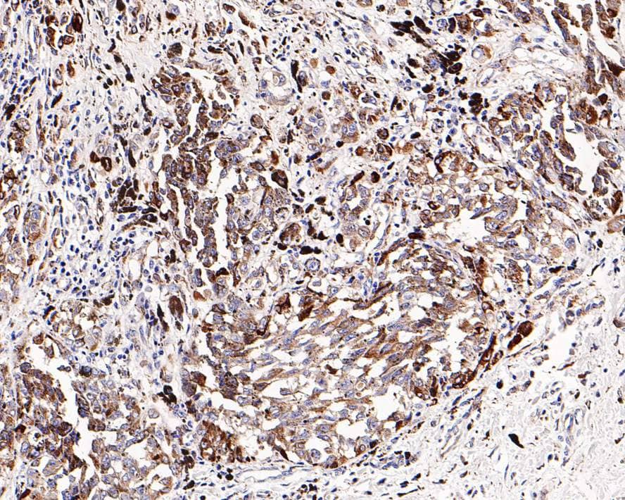 Immunohistochemistry: SPARC Antibody (PD00-57) [NBP3-32974] - Immunohistochemical analysis of paraffin-embedded human malignant melanoma tissue with Rabbit anti-SPARC antibody (NBP3-32974) at 1/500 dilution. The section was pre-treated using heat mediated antigen retrieval with Tris-EDTA buffer (pH 9.0) for 20 minutes. The tissues were blocked in 1% BSA for 20 minutes at room temperature, washed with ddH2O and PBS, and then probed with the primary antibody (NBP3-32974) at 1/500 dilution for 1 hour at room temperature. The detection was performed using an HRP conjugated compact polymer system. DAB was used as the chromogen. Tissues were counterstained with hematoxylin and mounted with DPX.