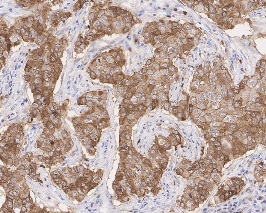 Immunohistochemistry: Stathmin 1 Antibody (PD00-54) [NBP3-32981] - Immunohistochemical analysis of paraffin-embedded human breast cancer tissue with Rabbit anti-Stathmin 1 antibody (NBP3-32981) at 1/2,000 dilution. The section was pre-treated using heat mediated antigen retrieval with Tris-EDTA buffer (pH 9.0) for 20 minutes. The tissues were blocked in 1% BSA for 20 minutes at room temperature, washed with ddH2O and PBS, and then probed with the primary antibody (NBP3-32981) at 1/2,000 dilution for 1 hour at room temperature. The detection was performed using an HRP conjugated compact polymer system. DAB was used as the chromogen. Tissues were counterstained with hematoxylin and mounted with DPX.