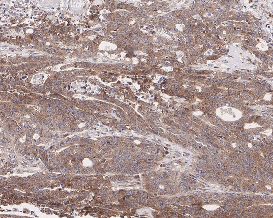 Immunohistochemistry: Tbp7 Antibody (JE62-72) [NBP3-32997] - Immunohistochemical analysis of paraffin-embedded human colon carcinoma tissue with Rabbit anti-Tbp7 antibody (NBP3-32997) at 1/1,000 dilution. The section was pre-treated using heat mediated antigen retrieval with Tris-EDTA buffer (pH 9.0) for 20 minutes. The tissues were blocked in 1% BSA for 20 minutes at room temperature, washed with ddH2O and PBS, and then probed with the primary antibody (NBP3-32997) at 1/1,000 dilution for 1 hour at room temperature. The detection was performed using an HRP conjugated compact polymer system. DAB was used as the chromogen. Tissues were counterstained with hematoxylin and mounted with DPX.