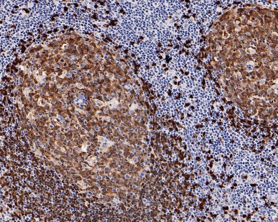 Immunohistochemistry: TCL1A Antibody (PD00-94) [NBP3-33001] - Immunohistochemical analysis of paraffin-embedded human tonsil tissue with Rabbit anti-TCL1A antibody (NBP3-33001) at 1/2,000 dilution. The section was pre-treated using heat mediated antigen retrieval with Tris-EDTA buffer (pH 9.0) for 20 minutes. The tissues were blocked in 1% BSA for 20 minutes at room temperature, washed with ddH2O and PBS, and then probed with the primary antibody (NBP3-33001) at 1/2,000 dilution for 1 hour at room temperature. The detection was performed using an HRP conjugated compact polymer system. DAB was used as the chromogen. Tissues were counterstained with hematoxylin and mounted with DPX.