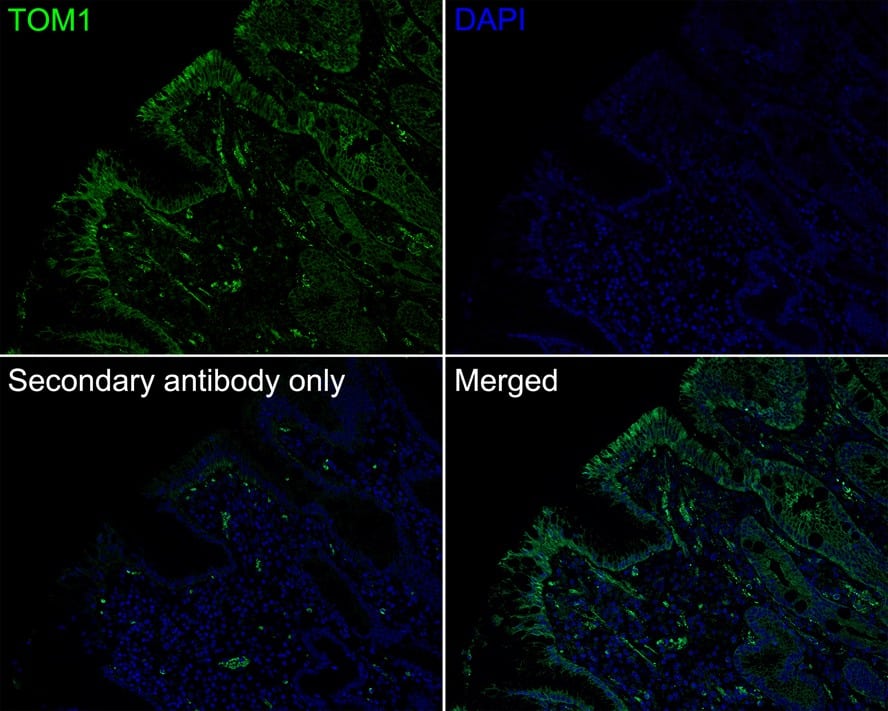 Immunohistochemistry: TOM1 Antibody (PSH03-38) [NBP3-33035] - Immunofluorescence analysis of paraffin-embedded human stomach carcinoma tissue labeling TOM1 with Rabbit anti-TOM1 antibody (NBP3-33035) at 1/200 dilution. The section was pre-treated using heat mediated antigen retrieval with Tris-EDTA buffer (pH 9.0) for 20 minutes. The tissues were blocked in 10% negative goat serum for 1 hour at room temperature, washed with PBS, and then probed with the primary antibody (NBP3-33035, green) at 1/200 dilution overnight at 4 ℃, washed with PBS. Goat Anti-Rabbit IgG H&L (iFluor™ 488) was used as the secondary antibody at 1/1,000 dilution. Nuclei were counterstained with DAPI (blue).