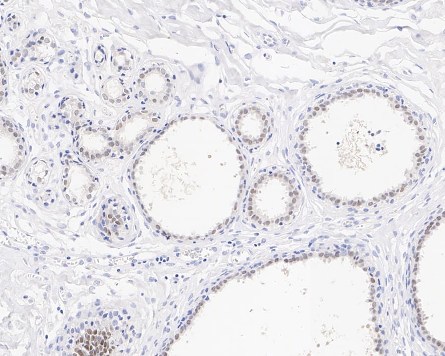 Immunohistochemistry: AP2 alpha Antibody (PSH02-05) [NBP3-33043] - Immunohistochemical analysis of paraffin-embedded human breast tissue with Rabbit anti-AP2 alpha antibody (NBP3-33043) at 1/1,000 dilution. The section was pre-treated using heat mediated antigen retrieval with Tris-EDTA buffer (pH 9.0) for 20 minutes. The tissues were blocked in 1% BSA for 20 minutes at room temperature, washed with ddH2O and PBS, and then probed with the primary antibody (NBP3-33043) at 1/1,000 dilution for 1 hour at room temperature. The detection was performed using an HRP conjugated compact polymer system. DAB was used as the chromogen. Tissues were counterstained with hematoxylin and mounted with DPX.