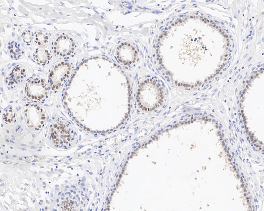 Immunohistochemistry: AP2 alpha Antibody (PSH02-06) [NBP3-33044] - Immunohistochemical analysis of paraffin-embedded human breast tissue with Rabbit anti-AP2 alpha antibody (NBP3-33044) at 1/1,000 dilution. The section was pre-treated using heat mediated antigen retrieval with Tris-EDTA buffer (pH 9.0) for 20 minutes. The tissues were blocked in 1% BSA for 20 minutes at room temperature, washed with ddH2O and PBS, and then probed with the primary antibody (NBP3-33044) at 1/1,000 dilution for 1 hour at room temperature. The detection was performed using an HRP conjugated compact polymer system. DAB was used as the chromogen. Tissues were counterstained with hematoxylin and mounted with DPX.