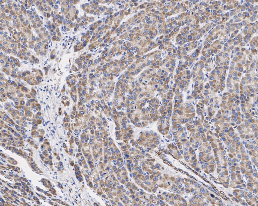 Immunohistochemistry: TRPM8 Antibody (JE32-58) [NBP3-33062] - Immunohistochemical analysis of paraffin-embedded human liver cancer tissue with Rabbit anti-TRPM8 antibody (NBP3-33062) at 1/500 dilution. The section was pre-treated using heat mediated antigen retrieval with Tris-EDTA buffer (pH 9.0) for 20 minutes. The tissues were blocked in 1% BSA for 20 minutes at room temperature, washed with ddH2O and PBS, and then probed with the primary antibody (NBP3-33062) at 1/500 dilution for 1 hour at room temperature. The detection was performed using an HRP conjugated compact polymer system. DAB was used as the chromogen. Tissues were counterstained with hematoxylin and mounted with DPX.