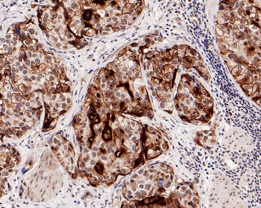 Immunohistochemistry: Uroplakin III Antibody (PD00-09) [NBP3-33086] - Immunohistochemical analysis of paraffin-embedded human bladder carcinoma tissue with Rabbit anti-Uroplakin III antibody (NBP3-33086) at 1/5,000 dilution. The section was pre-treated using heat mediated antigen retrieval with Tris-EDTA buffer (pH 9.0) for 20 minutes. The tissues were blocked in 1% BSA for 20 minutes at room temperature, washed with ddH2O and PBS, and then probed with the primary antibody (NBP3-33086) at 1/5,000 dilution for 1 hour at room temperature. The detection was performed using an HRP conjugated compact polymer system. DAB was used as the chromogen. Tissues were counterstained with hematoxylin and mounted with DPX.