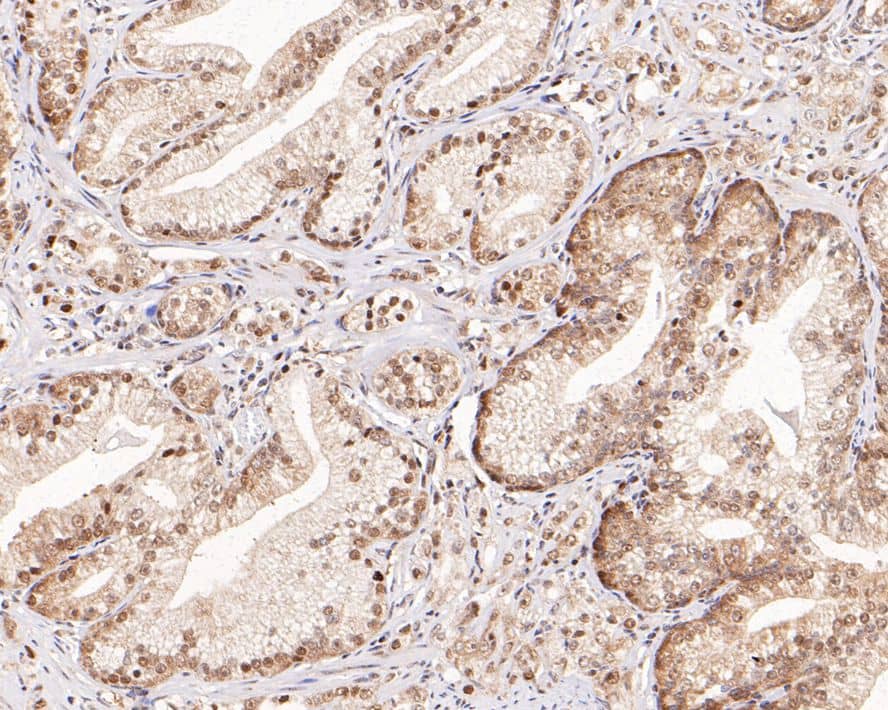 Immunohistochemistry: WDR77 Antibody (PSH0-07) [NBP3-33101] - Immunohistochemical analysis of paraffin-embedded human prostate tissue with Rabbit anti-WDR77 antibody (NBP3-33101) at 1/1,000 dilution. The section was pre-treated using heat mediated antigen retrieval with sodium citrate buffer (pH 6.0) for 2 minutes. The tissues were blocked in 1% BSA for 20 minutes at room temperature, washed with ddH2O and PBS, and then probed with the primary antibody (NBP3-33101) at 1/1,000 dilution for 1 hour at room temperature. The detection was performed using an HRP conjugated compact polymer system. DAB was used as the chromogen. Tissues were counterstained with hematoxylin and mounted with DPX.