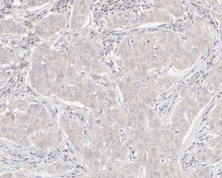 Immunohistochemistry: XIAP Antibody (PSH04-30) [NBP3-33105] - Immunohistochemical analysis of paraffin-embedded human breast cancer tissue with Rabbit anti-XIAP antibody (NBP3-33105) at 1/50 dilution. The section was pre-treated using heat mediated antigen retrieval with sodium citrate buffer (pH 6.0) for 2 minutes. The tissues were blocked in 1% BSA for 20 minutes at room temperature, washed with ddH2O and PBS, and then probed with the primary antibody (NBP3-33105) at 1/50 dilution for 1 hour at room temperature. The detection was performed using an HRP conjugated compact polymer system. DAB was used as the chromogen. Tissues were counterstained with hematoxylin and mounted with DPX.