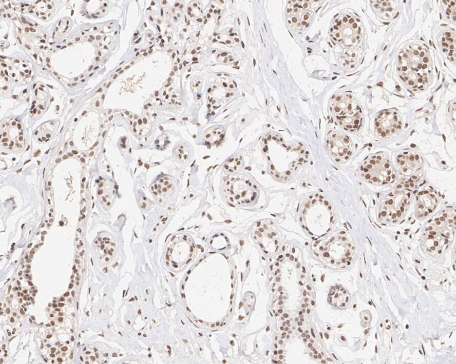 Immunohistochemistry: XLF Antibody (PSH01-07) [NBP3-33106] - Immunohistochemical analysis of paraffin-embedded human breast tissue with Rabbit anti-XLF antibody (NBP3-33106) at 1/1,000 dilution. The section was pre-treated using heat mediated antigen retrieval with sodium citrate buffer (pH 6.0) for 2 minutes. The tissues were blocked in 1% BSA for 20 minutes at room temperature, washed with ddH2O and PBS, and then probed with the primary antibody (NBP3-33106) at 1/1,000 dilution for 1 hour at room temperature. The detection was performed using an HRP conjugated compact polymer system. DAB was used as the chromogen. Tissues were counterstained with hematoxylin and mounted with DPX.