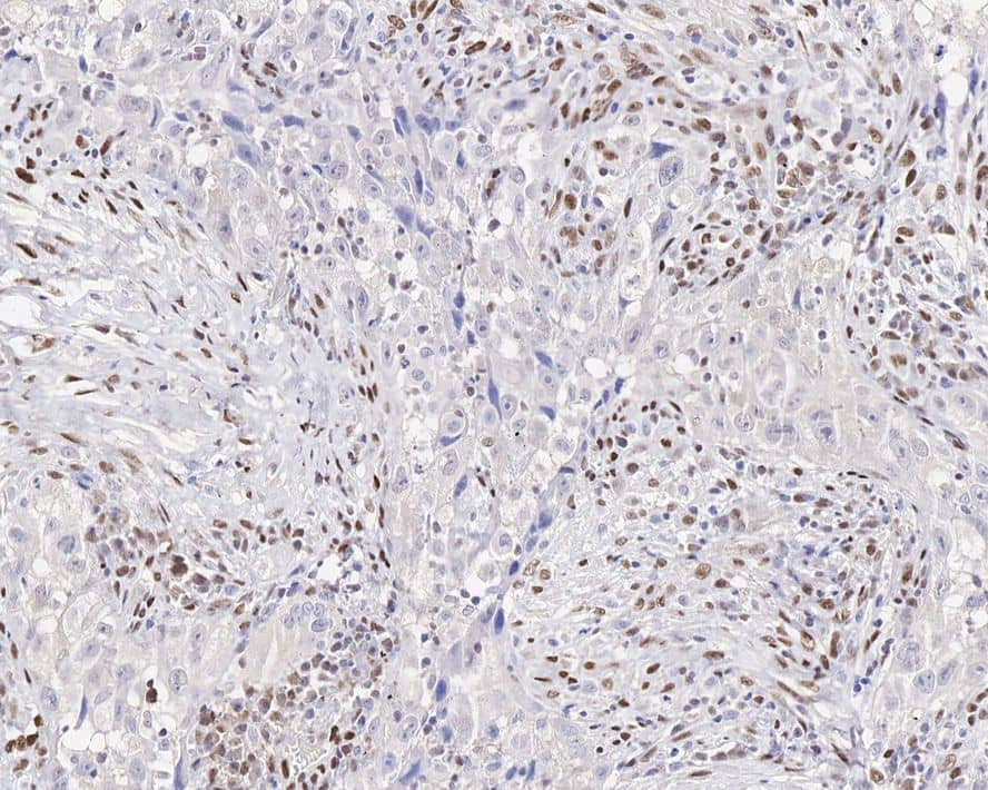 Immunohistochemistry: ZEB1 Antibody (JE57-64) [NBP3-33111] - Immunohistochemical analysis of paraffin-embedded human lung carcinoma tissue with Rabbit anti-ZEB1 antibody (NBP3-33111) at 1/200 dilution. The section was pre-treated using heat mediated antigen retrieval with sodium citrate buffer (pH 6.0) for 2 minutes. The tissues were blocked in 1% BSA for 20 minutes at room temperature, washed with ddH2O and PBS, and then probed with the primary antibody (NBP3-33111) at 1/200 dilution for 1 hour at room temperature. The detection was performed using an HRP conjugated compact polymer system. DAB was used as the chromogen. Tissues were counterstained with hematoxylin and mounted with DPX.